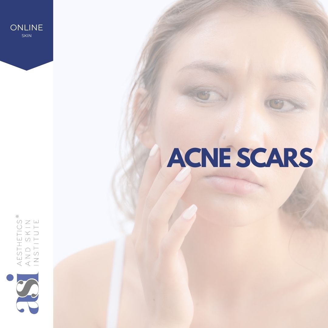 Acne Scars